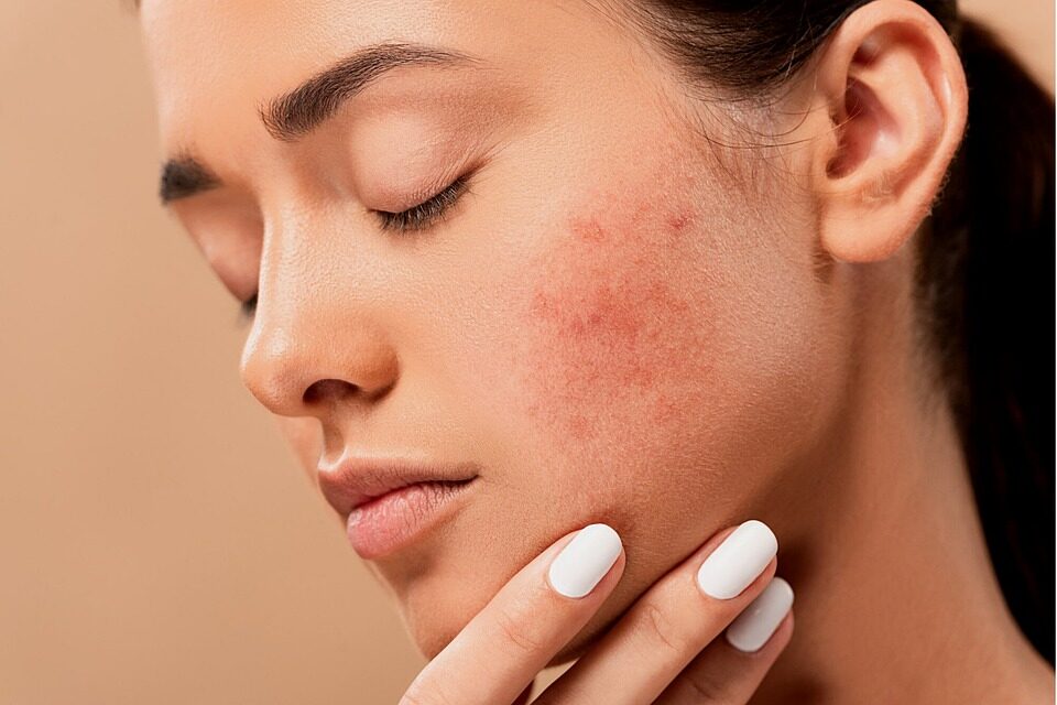 acne-5561750_960_720